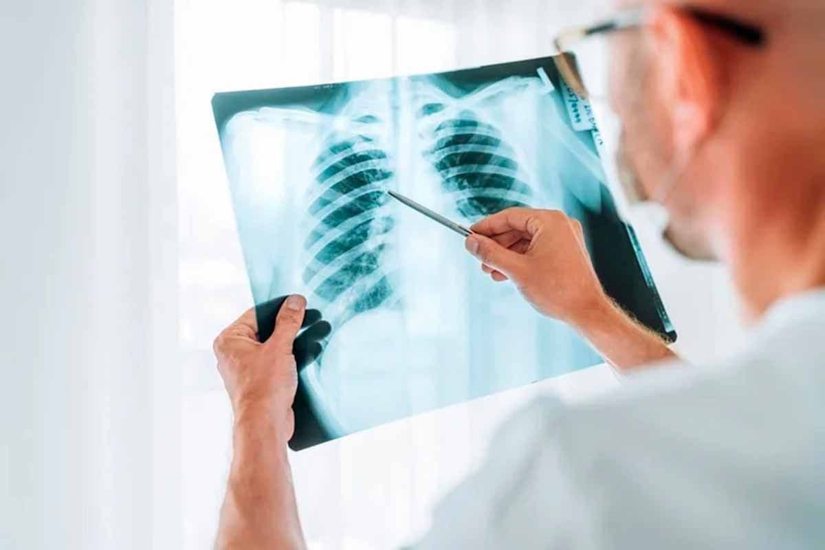 Cáncer de pulmón en Argentina: La importancia de la detección temprana y los desafíos para ampliar el acceso al tamizaje